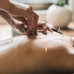A person is getting acupuncture on their back.
