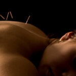 acupuncture